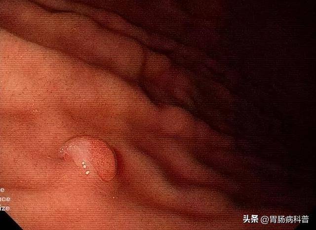 胃息肉，会变成胃癌吗？哪些需要切除？