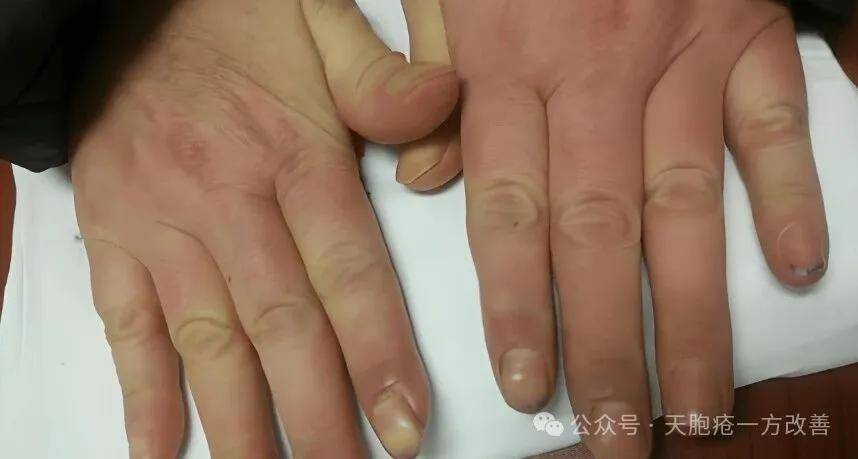 终结天疱疮反复，健脾祛湿方剂守护肌肤健康