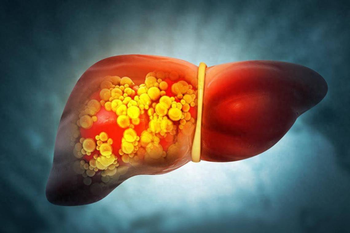 原创            偶尔喝点没关系？酒精肝早期几乎没症状！隐形期长达5-10年