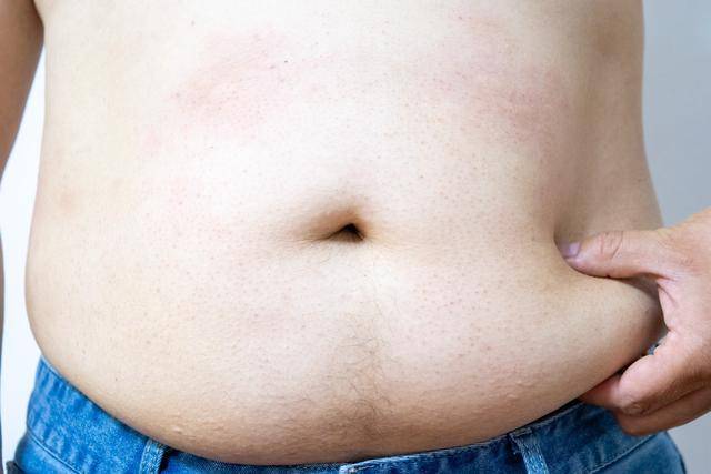 越减越肥、越减越病？只靠减肥药或不够，专家：特定人群需考虑手术治疗