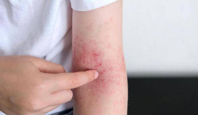 湿疹反复老不好？医生：别乱抹药膏了！3个方法从根上“断舍离”