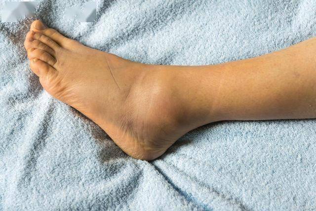 体内有栓，腿部先知？提醒：腿部若常有这3种异常，警惕血栓形成