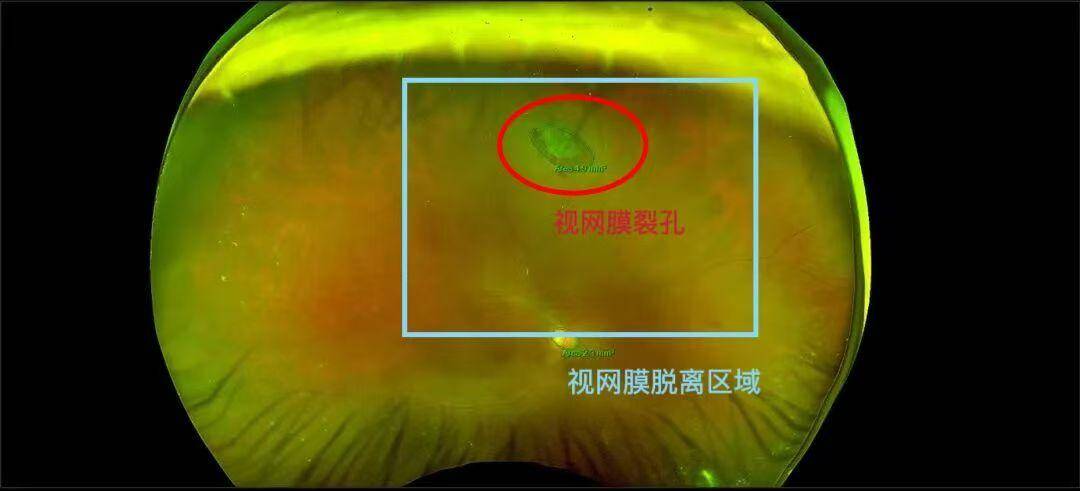 视网膜脱离，如何靠“打气”就能贴回？