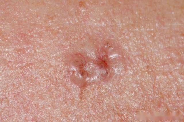 带状疱疹的3款经典中成药！分阶段对症用，快速止痛防后遗