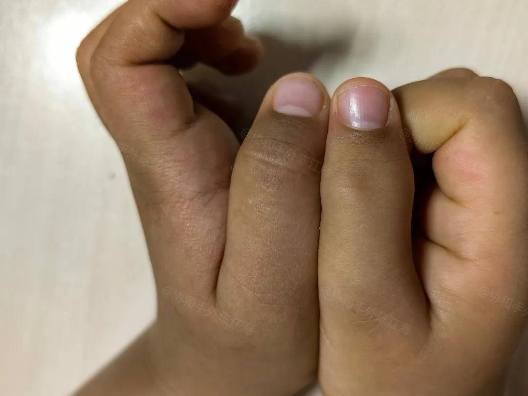 原创            《多指案例63丨猜猜看宝宝哪个大拇指做过手术？》