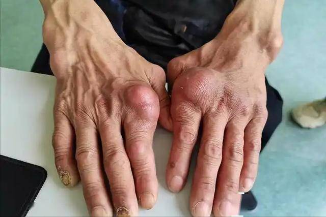 医生发现：能活到80岁的痛风患者，大多在55岁，就不做这5件事了