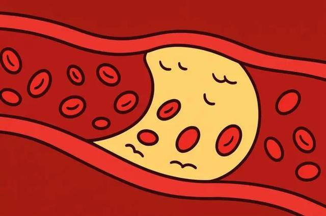 别只知道吃他汀！研究：5类天然营养，或可助力降脂，稳定斑块