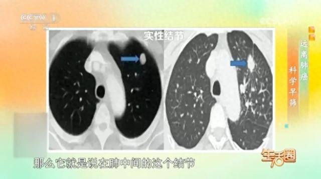 早期大多无症状！身体出现这6种情况，可能是肺癌的信号→