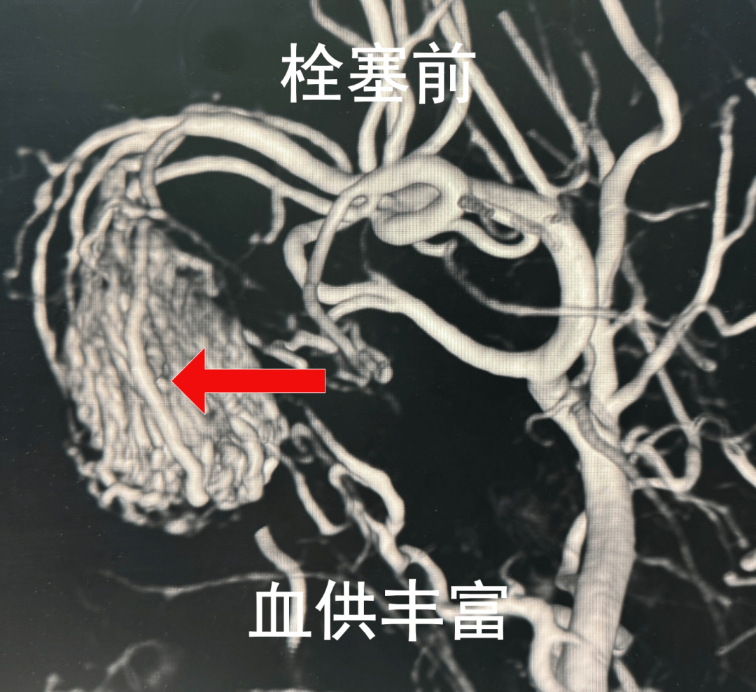 17岁少年鼻塞3年，反复流鼻血，医生一查：不是鼻炎，是肿瘤！