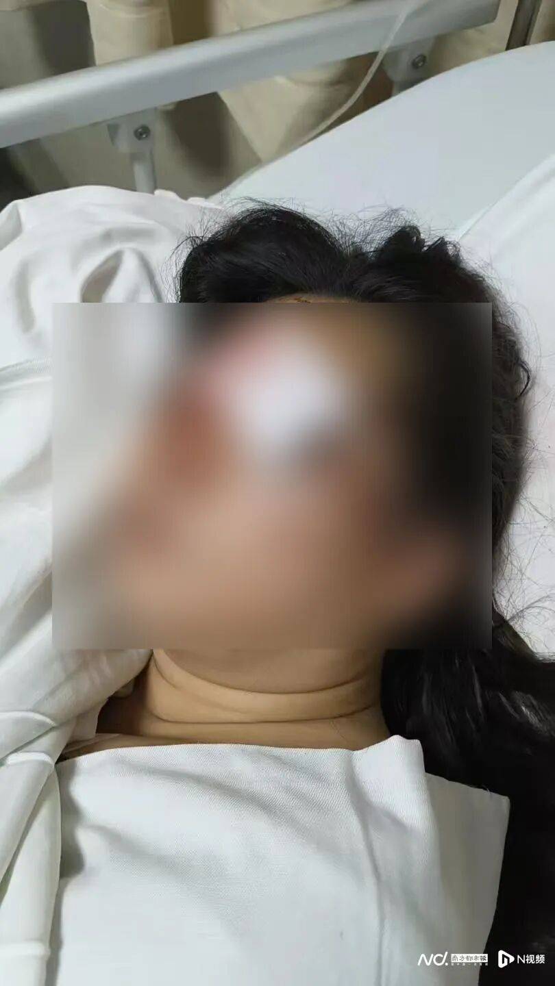 两小孩放烟花，炸伤一女子