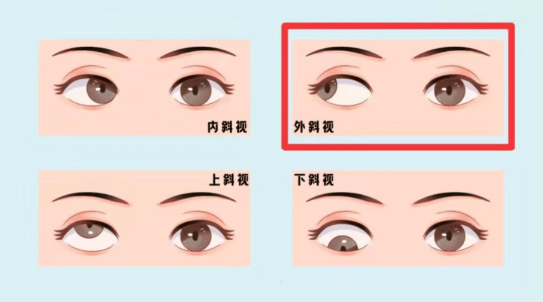 泉州爱尔金丽文医生解读：成人斜视手术，修复视功能更治愈心理困扰